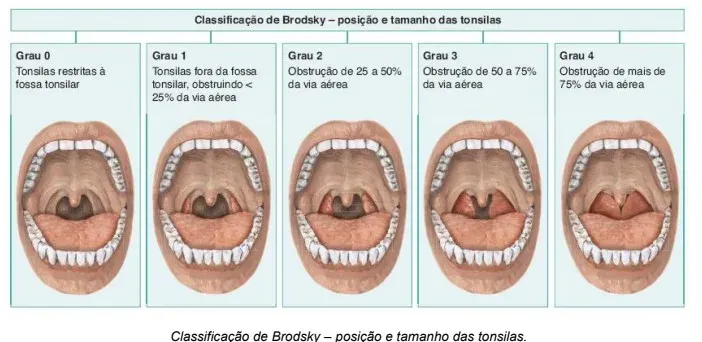 Classificação de Brodsky em cinco graus, do grau 0 ao grau 4, mostrando o quanto as amígdalas ocupam da via aérea: de restritas à fossa tonsilar até obstrução de mais de 75%